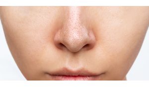 Як позбутися чорних цяток?