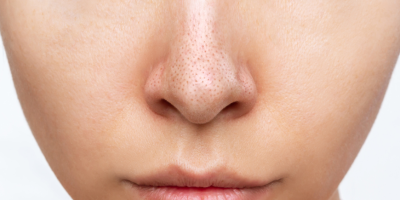 Як позбутися чорних цяток?