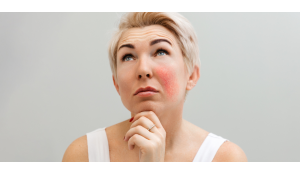 Що таке купероз? Захворювання чи косметичний дефект?